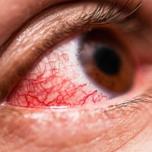 ¿Hay un brote de conjuntivitis en el país?